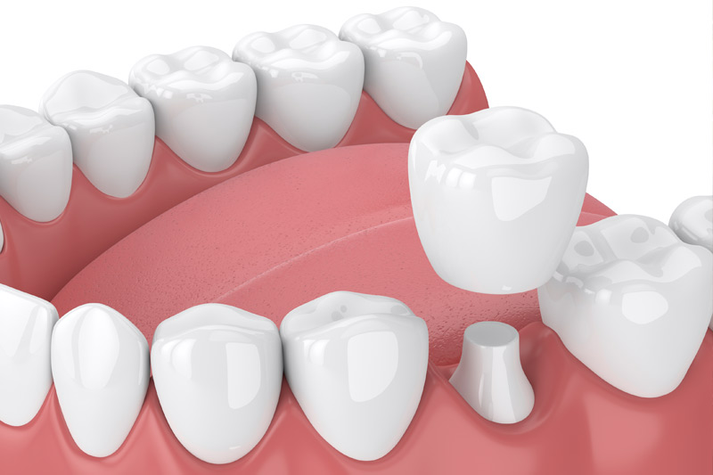 Dental Crowns in Torrance