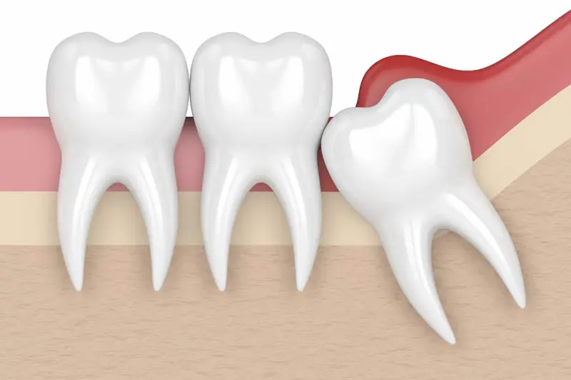 Impacted wisdom tooth illustration