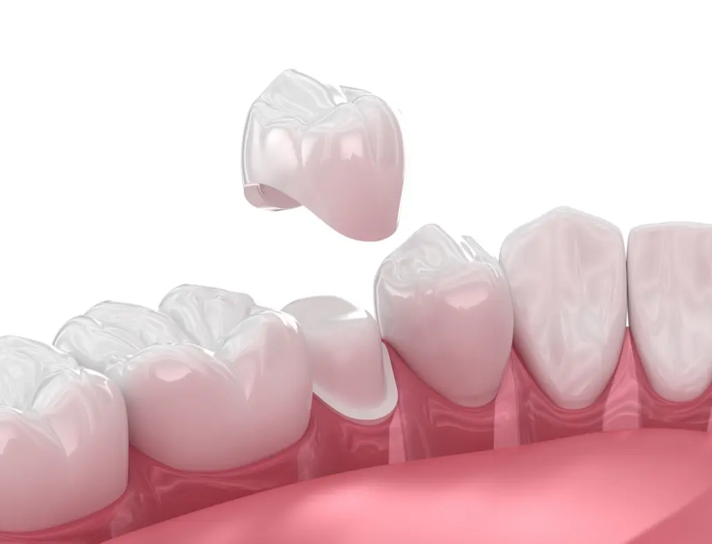 Dental crown placement on molar tooth