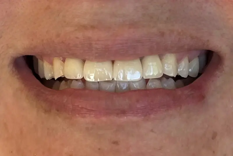 Teeth showing in a friendly grin