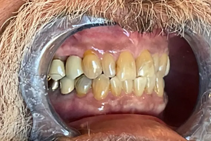 Close-up of teeth with dental retractor