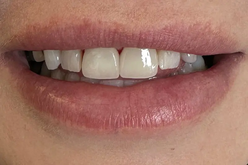 Natural smile showing teeth