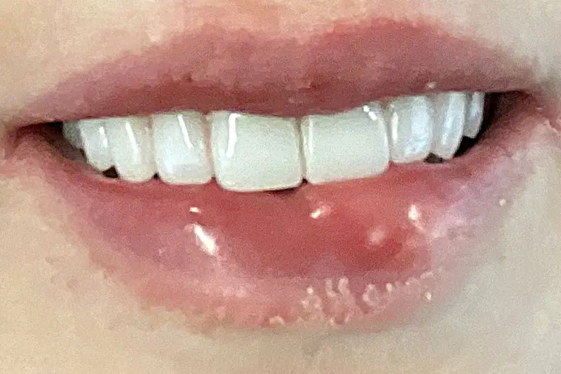 Person's lips with visible cold sore