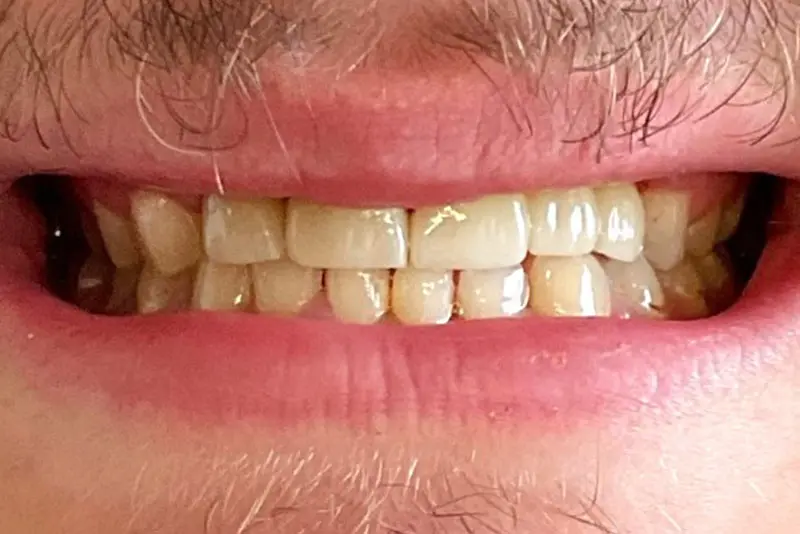 Teeth showing behind lips