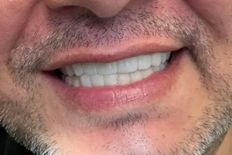 Facial stubble and smiling mouth