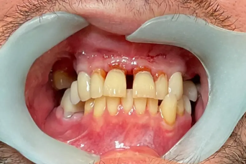 Teeth alignment with dental retractor in place