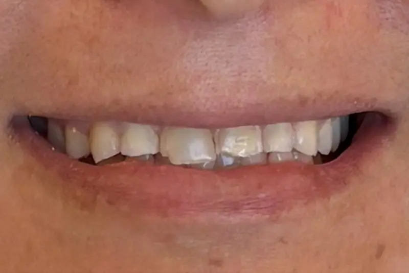 Person's teeth in a close-up smile