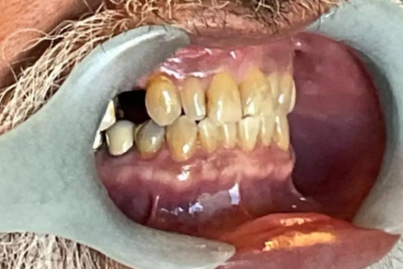 Teeth and gums with dental tool