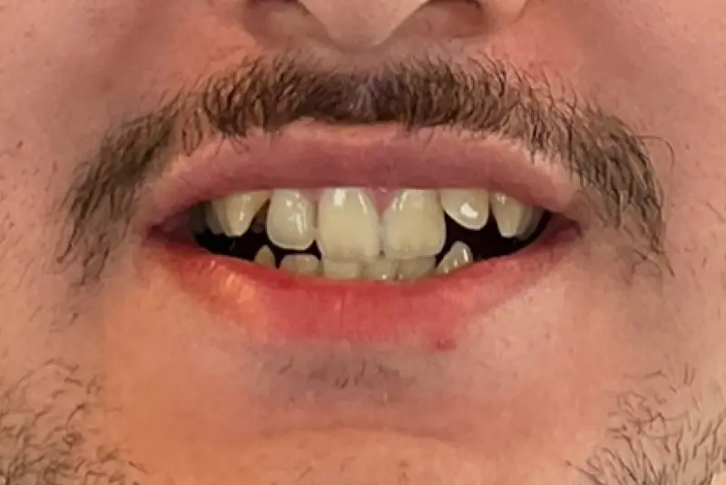Person smiling with uneven teeth