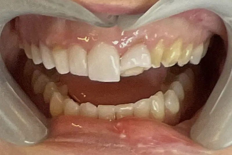 Close-up of damaged upper tooth