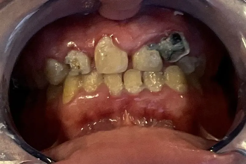 Close-up of damaged and decayed teeth