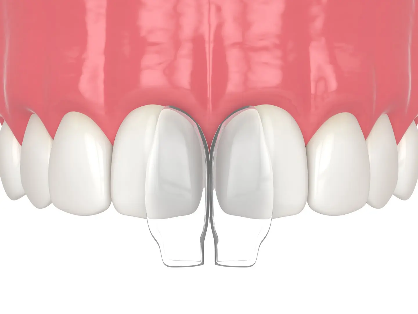 Dental veneers on front teeth illustration