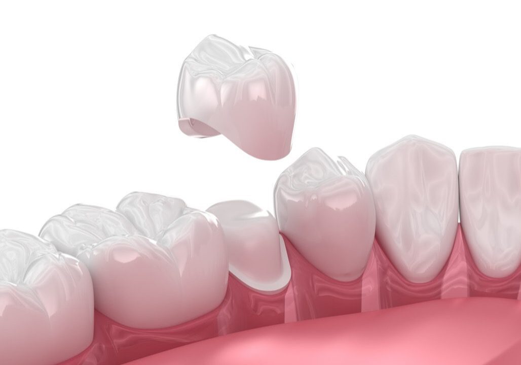 Dental crown placement on molar tooth