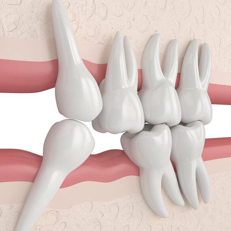 Impacted wisdom tooth illustration