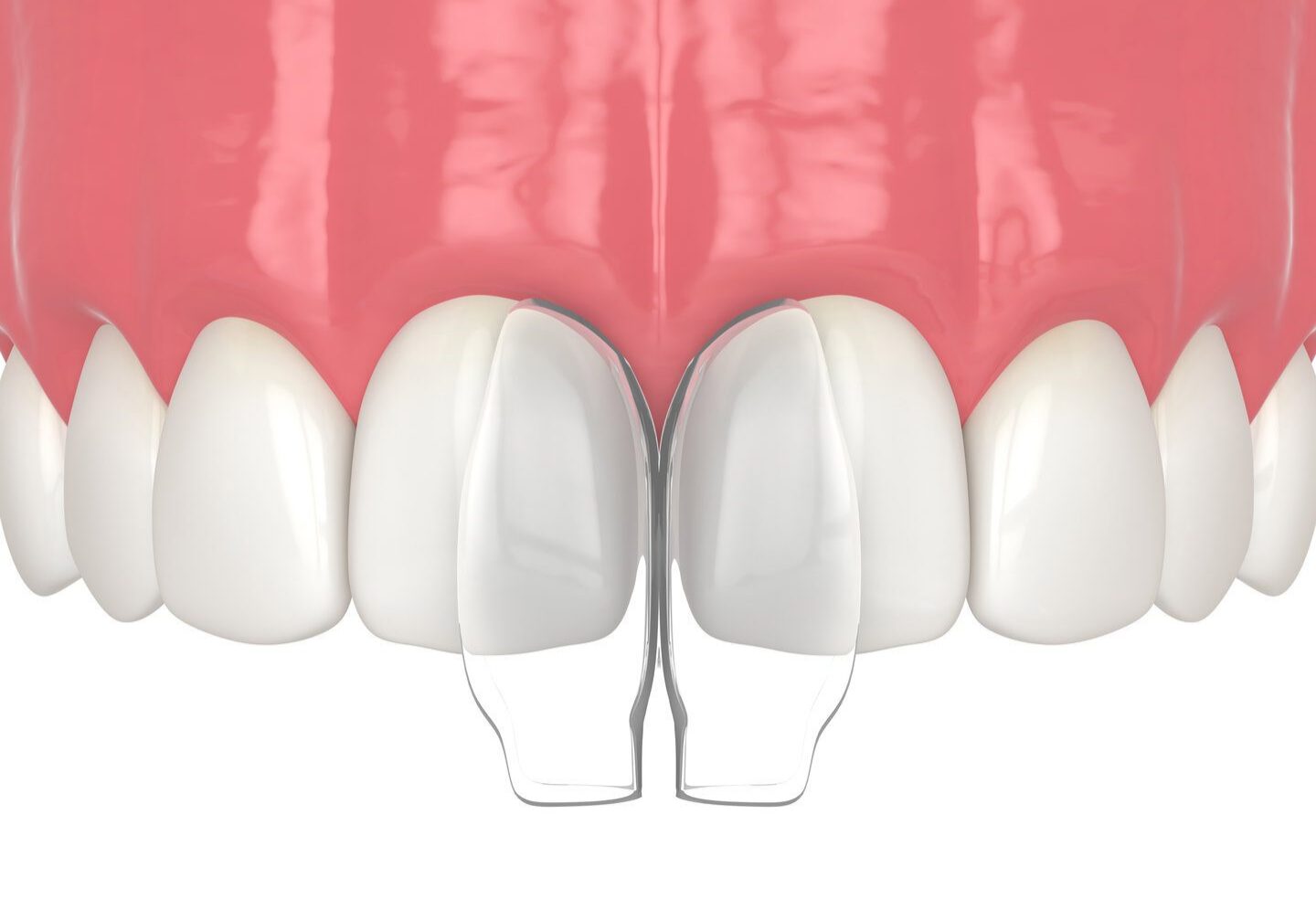 Dental veneers on front teeth illustration